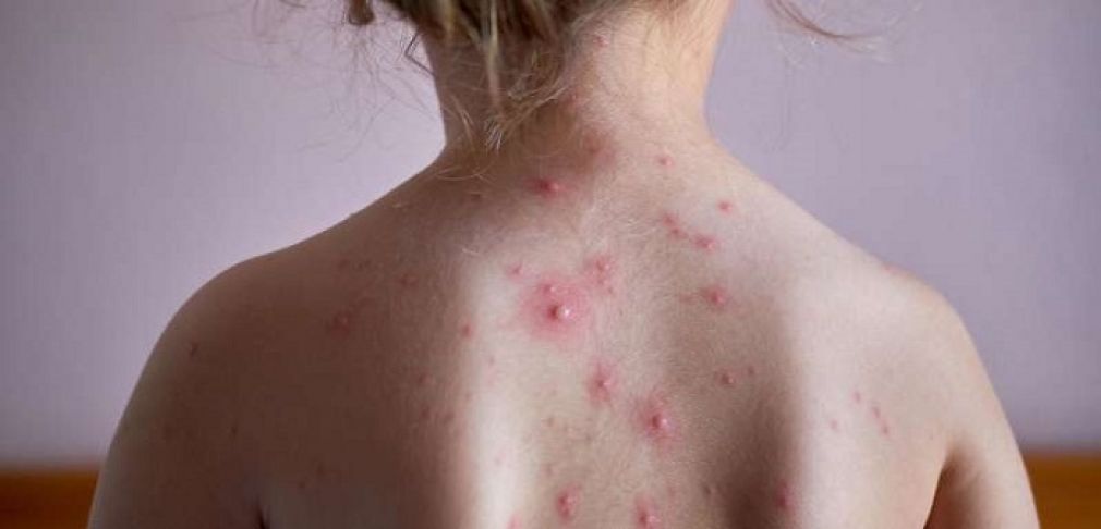 Voici les symptômes de la varicelle