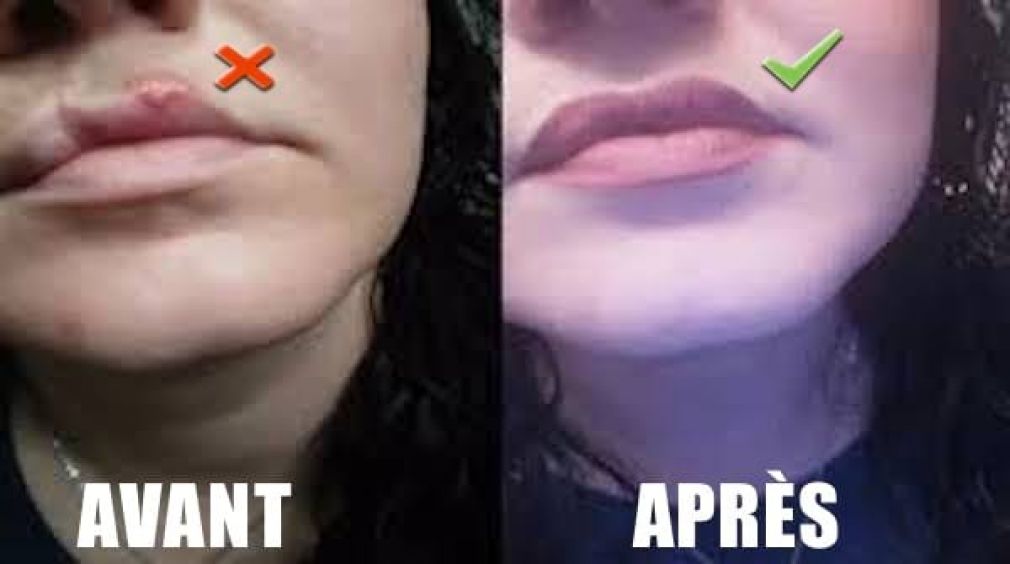 Comment soigner rapidement une herpès à la lèvre